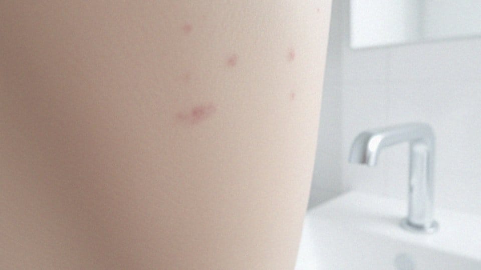 Jakie są przyczyny powstawania czerwonych kropki na ciele?