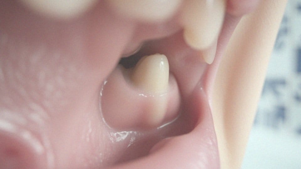 Ile boli rosnąca ósemka? Objawy i sposoby na złagodzenie bólu